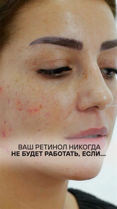 Как избежать нежелательных эффектов при совместном применении Рабифела и Мультифела